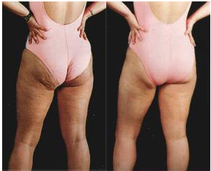 cellulite e buccia d arancia prime e dopo